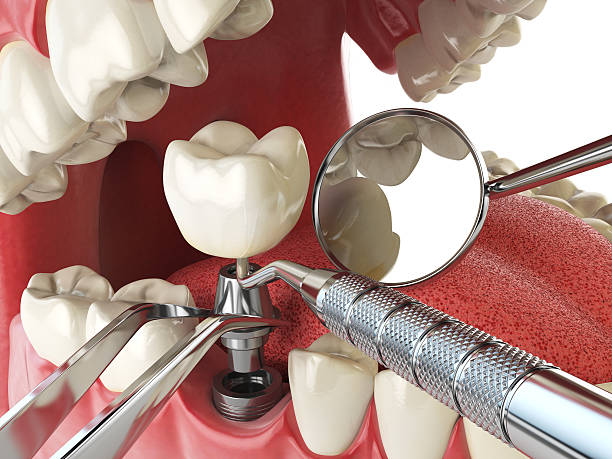Best Emergency Tooth Extraction in Waterville, MN